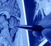 Neurologos en Saltillo